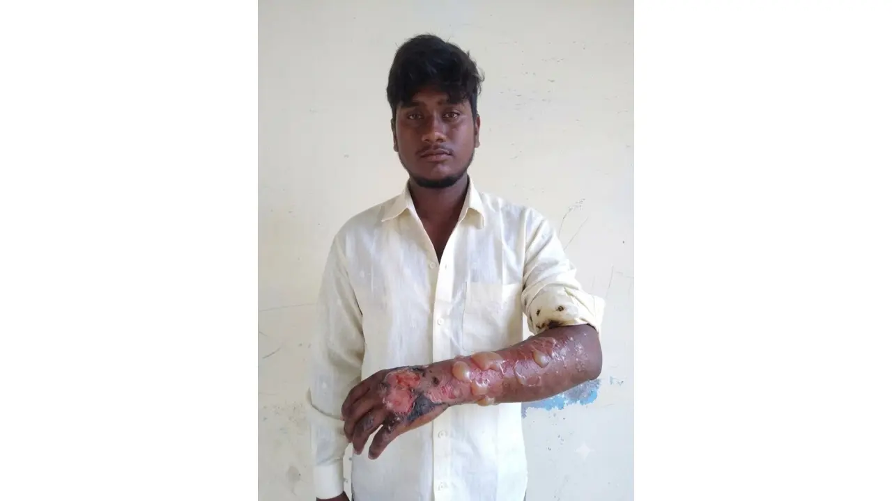 A teenager hand injured with severe burn blisters caused by a Mobile Battery Blast